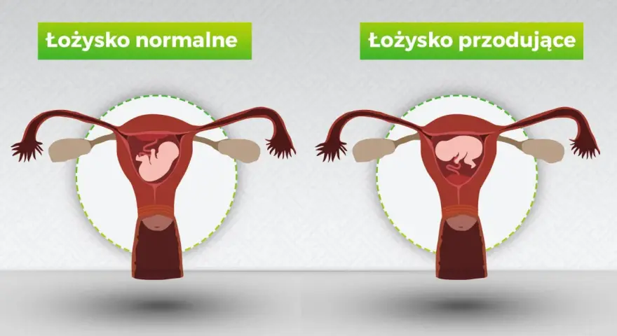Porównanie: łożysko normalne vs. łożysko przodujące. Ilustracja pokazuje macicę z płodem, gdzie w jednym przypadku łożysko jest prawidłowo umiejscowione, a w drugim przoduje.