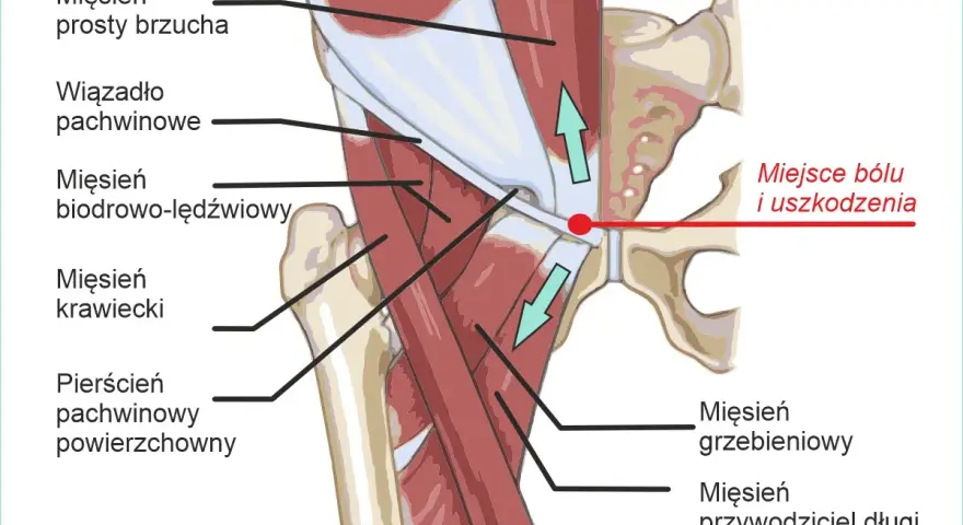 Anatomia pachwiny z zaznaczonym miejscem bólu i uszkodzenia. Ilustracja pokazuje mięśnie brzucha, biodrowo-lędźwiowy, krawiecki, grzebieniowy, przywodziciel długi oraz wiązadło pachwinowe.