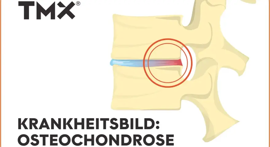 Darstellung eines Wirbels mit Bandscheibenschaden. Bei Osteochondrose wie geht es weiter? TMX Logo.