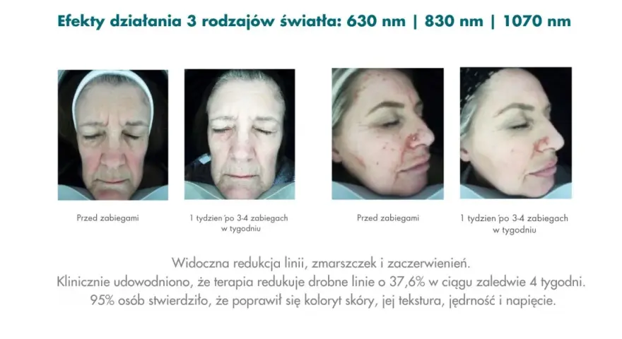 Przed i po terapii światłem LED w domu. Zmniejszenie zmarszczek i zaczerwienień. Poprawa kolorytu, tekstury i jędrności skóry.