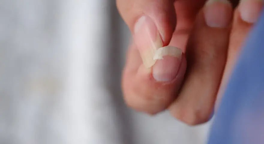 Un ongle se casse, une question se pose : pourquoi mes ongles se cassent ? Gros plan sur un ongle abîmé.