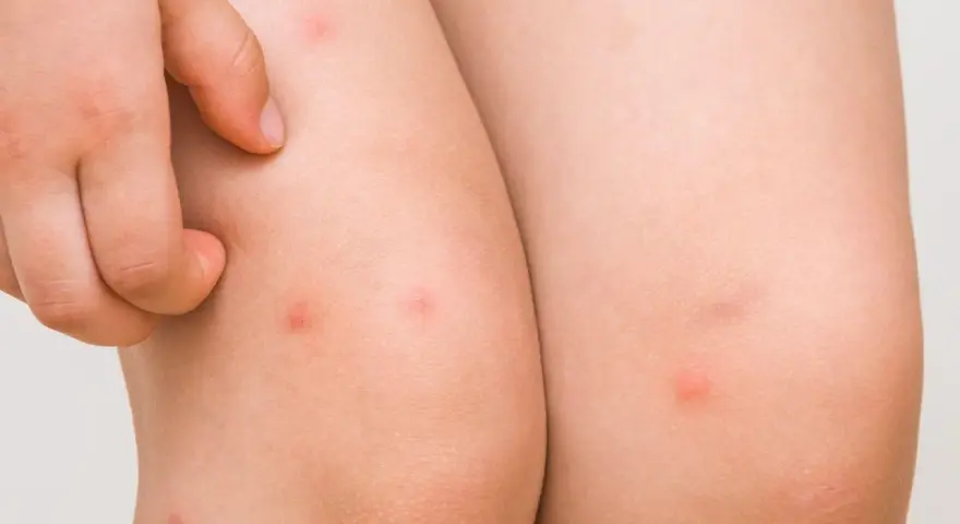 Piel de niño con pequeños bultos rojos, indicativos de foliculitis en las piernas.