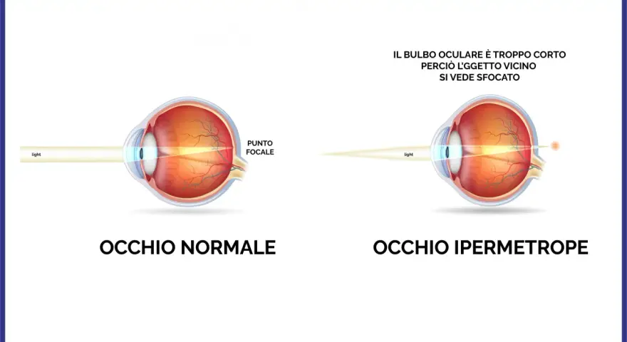 Confronto tra occhio normale e occhio ipermetrope: in quest'ultimo, il bulbo corto fa sì che l'oggetto vicino si veda sfocato.