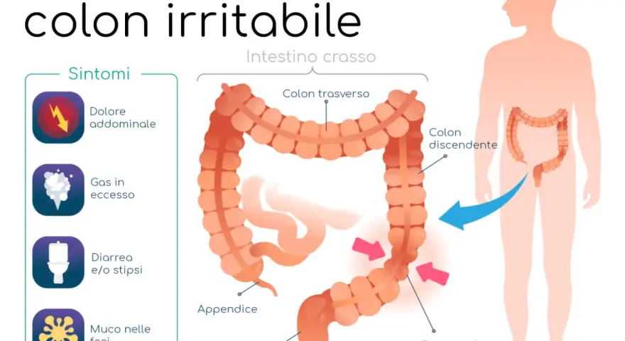 Sintomi del colon irritabile: dolore addominale, gas, diarrea/stipsi e muco. Il colon è evidenziato in un corpo umano.
