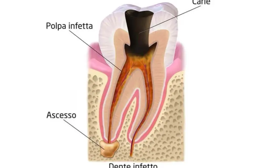 Ascesso mascellare - Sintomi, cause e cure efficaci