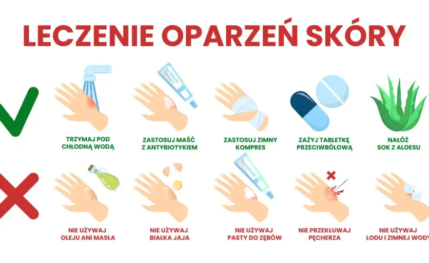 Oparzenie 2. stopnia - Co robić, kiedy iść do lekarza?