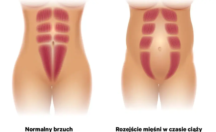 Rozejście mięśni brzucha u dziecka - Kiedy się martwić?