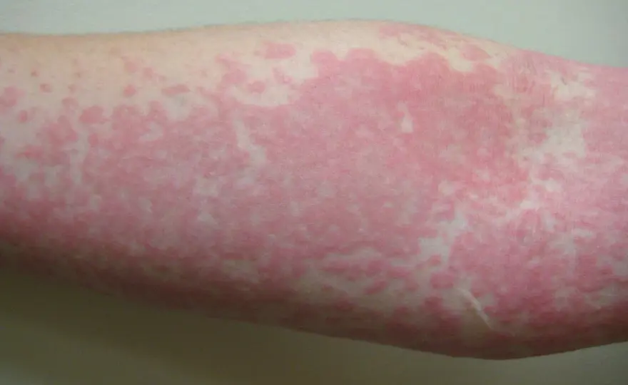 ¿Ronchas con picor? - Cómo identificar la urticaria y qué hacer
