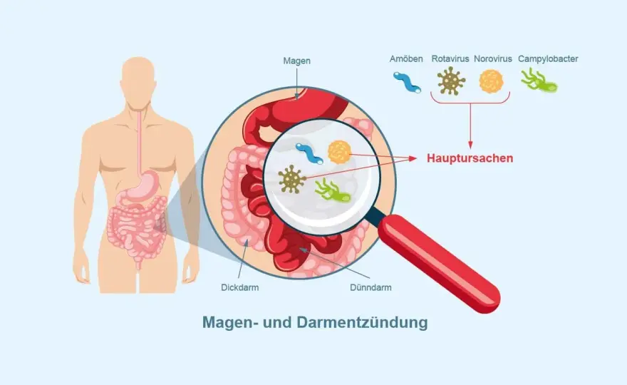 Symptome von Magen Darm: Warnzeichen einer ernsten Infektion erkennen