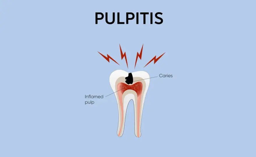 Dolore al dente, pulpite o carie? Come capirlo davvero