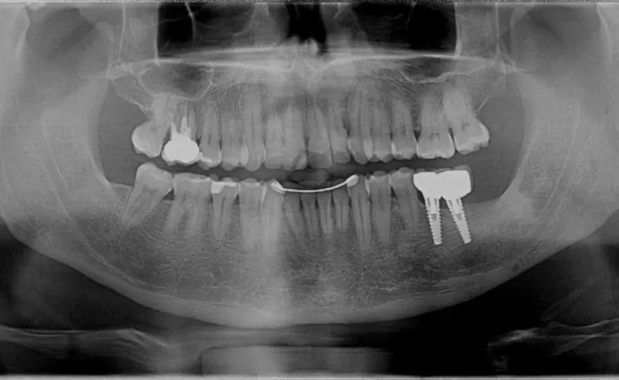 Tasca gengivale - Cosa significa e come chiuderla?