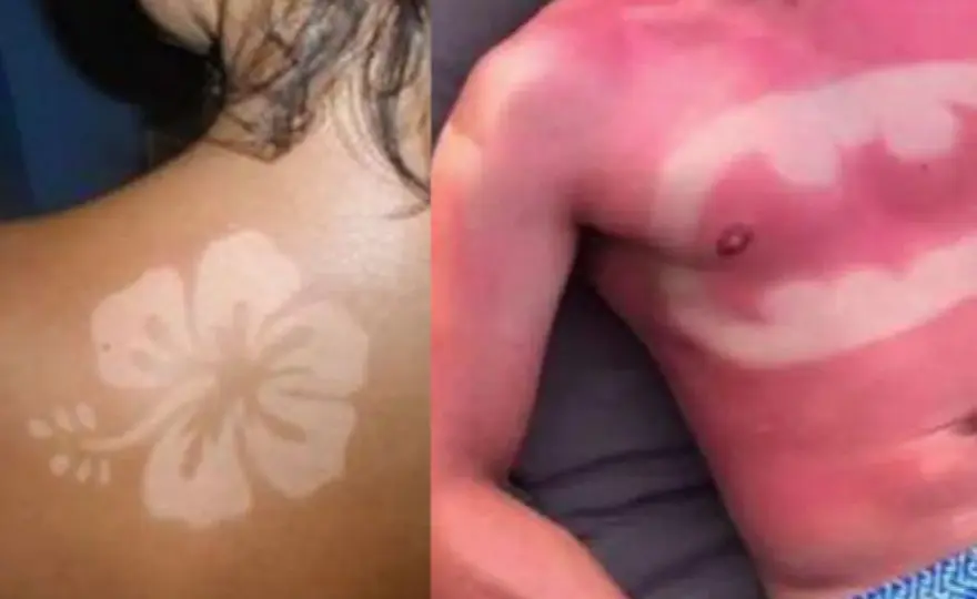 Coup de soleil sur un tatouage - que faire ?