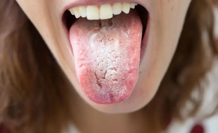 Candida in bocca - sintomi, cause, cure e segnali d’allarme