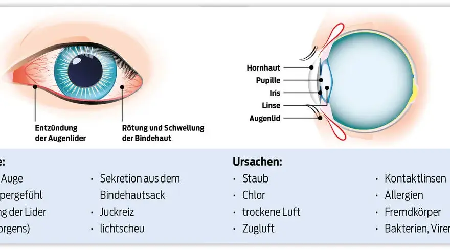 Wirksame Medikamente gegen Bindehautentzündung: Tipps und Empfehlungen