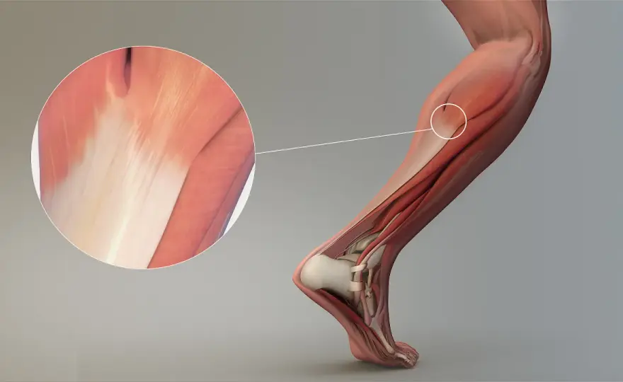 Tendon po polsku: Co to jest ścięgno i jak o nie dbać?