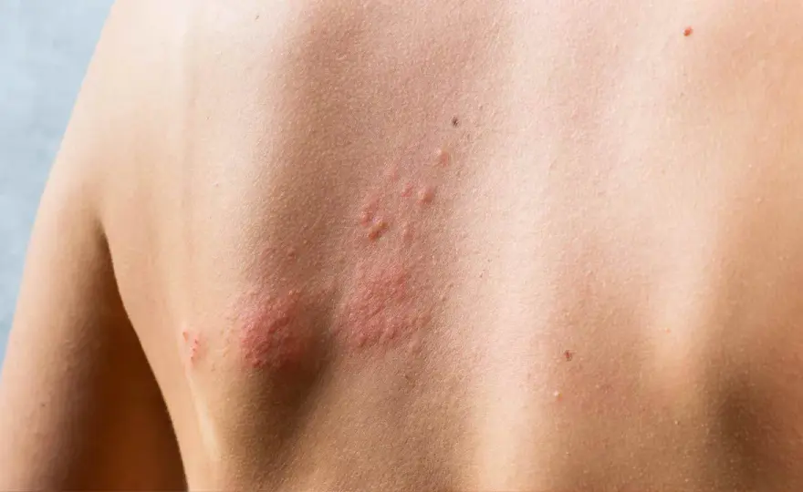 Sarpullido con picor - Causas, alivio y cuándo consultar