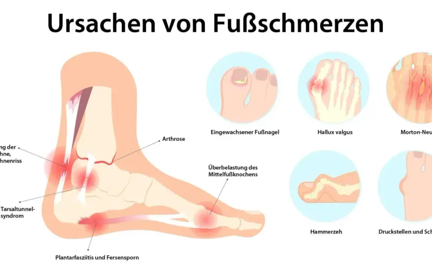 Fußschmerzen - Ursachen, Hilfe & wann zum Arzt?