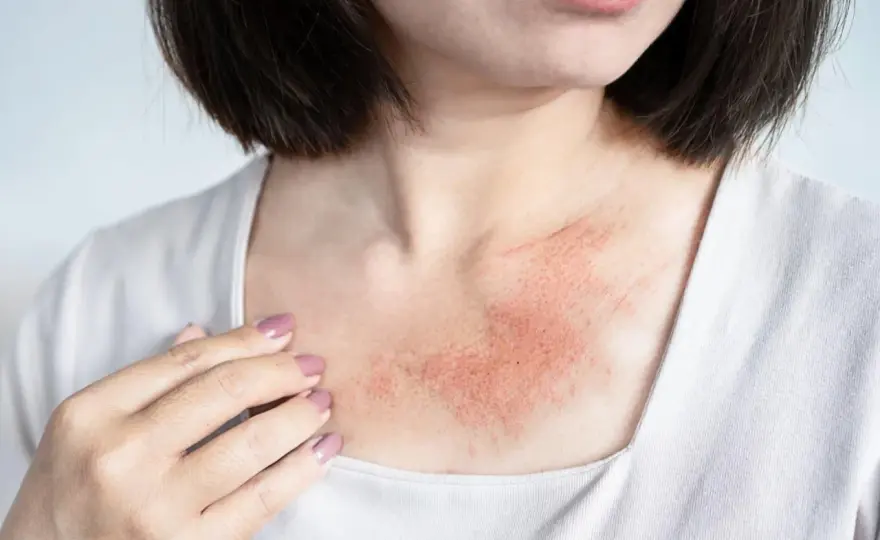 Pollenallergie Hautausschlag - Was wirklich hilft