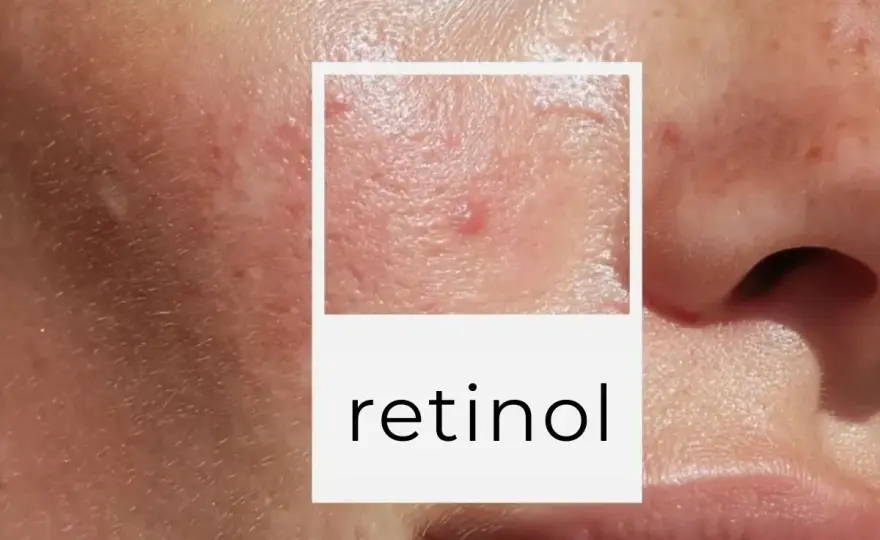 Retinol do twarzy - jak zacząć i nie podrażnić skóry