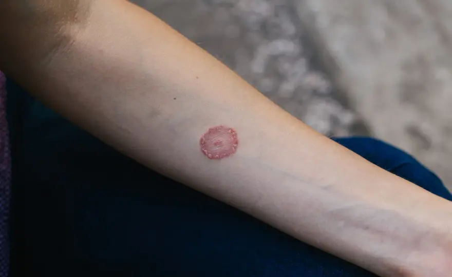 Tigna nei bambini - segnali, cure e contagio da evitare