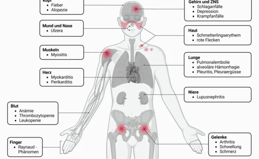 Lupus Symptome: Erkennen Sie die alarmierenden Anzeichen rechtzeitig