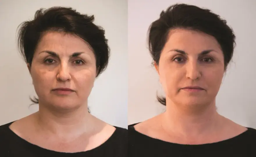Radiesse efekty - Kiedy widać rezultaty i czy warto?
