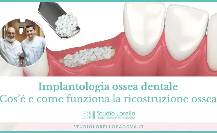 Implantologia ossea dentale - tecniche, tempi e costi