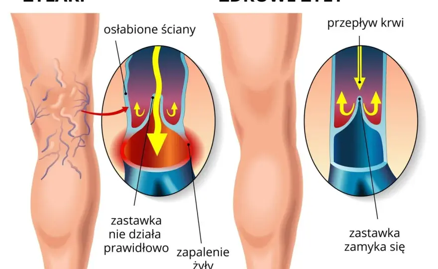 Zastawki żylne - jak działają i dlaczego prowadzą do żylaków?