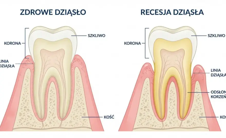 Kiretaż dziąseł - ratunek dla chorych dziąseł?