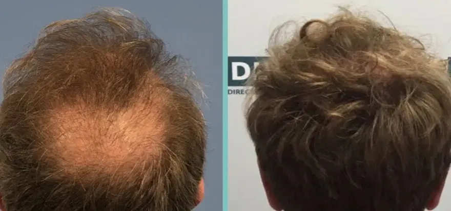 Biotin für Haare: Vorher-Nachher-Ergebnisse & realistische Erwartungen