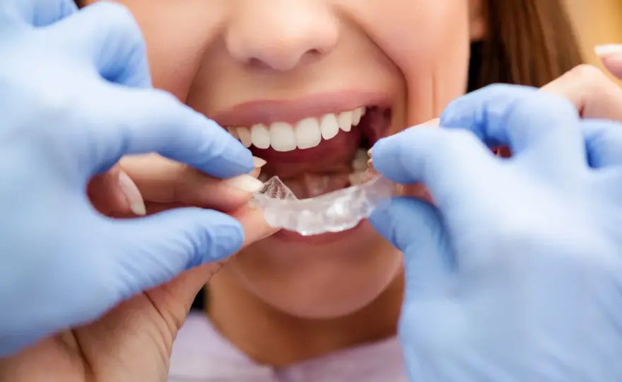Evolución de Invisalign mes a mes - qué cambios esperar