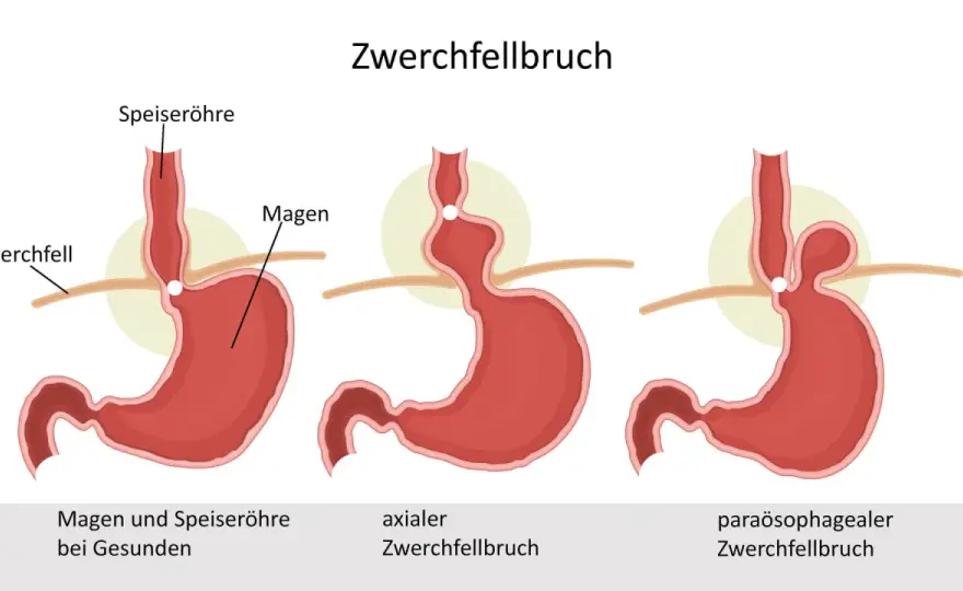 Zwerchfellbruch erkennen - typische Symptome und Warnzeichen