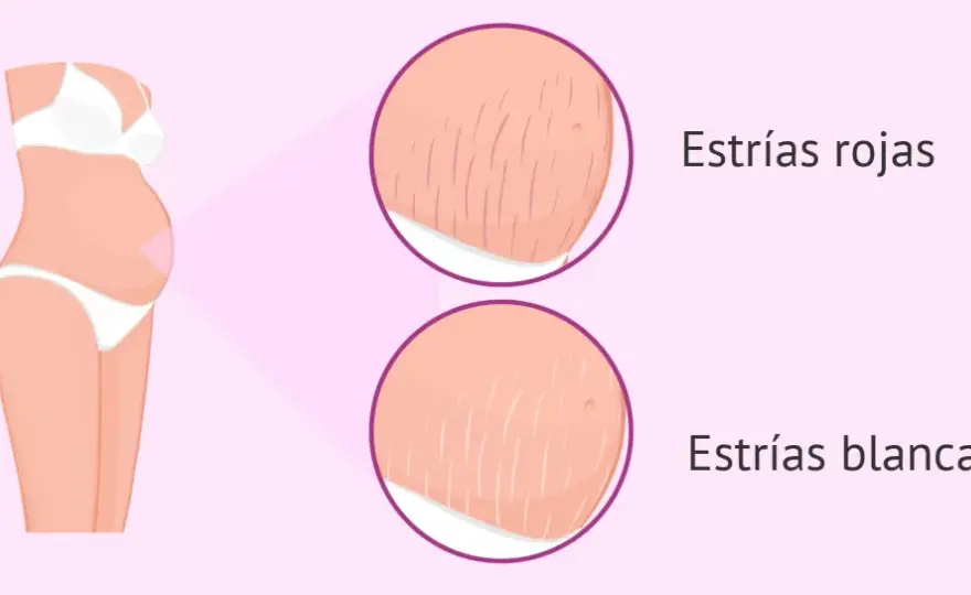 Estrías del embarazo - Lo que funciona y lo que debes evitar