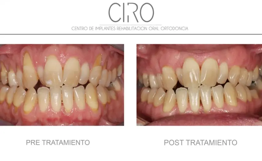 Mantenimiento periodontal para evitar recaídas de periodontitis