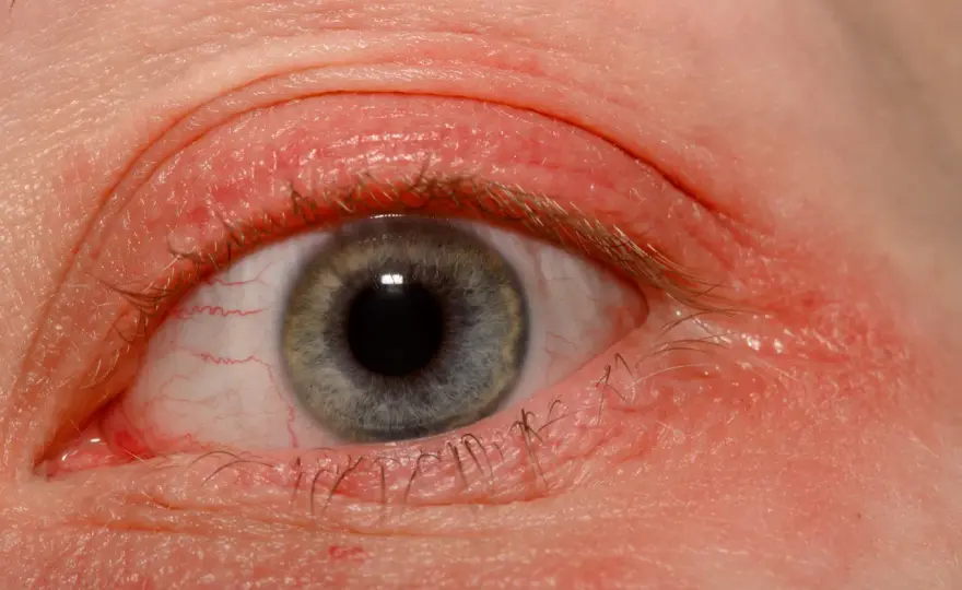 Alergia na klej do rzęs: Jak rozpoznać objawy i skutecznie działać?