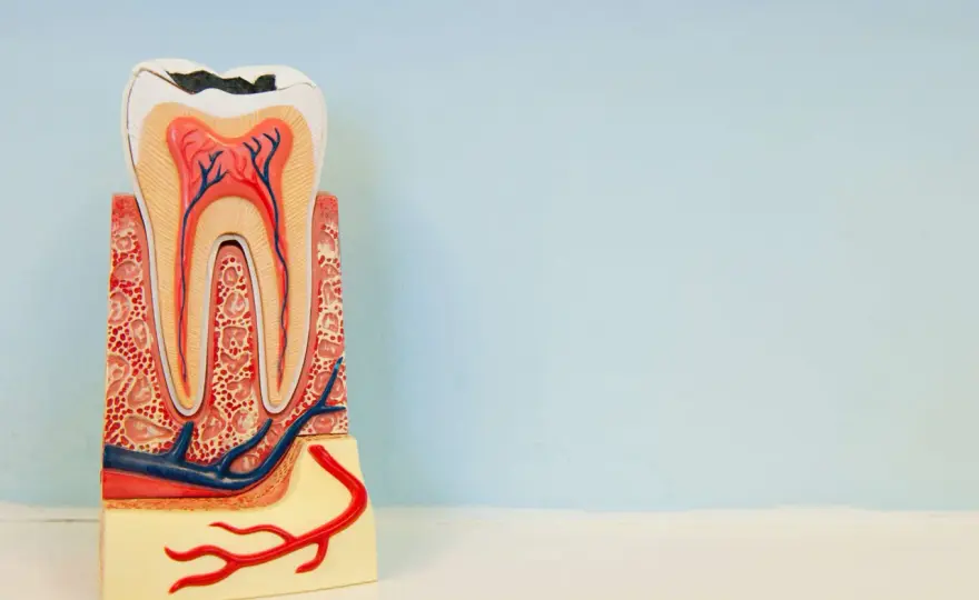 Pulpa dental expuesta - qué hacer y cuándo se puede salvar