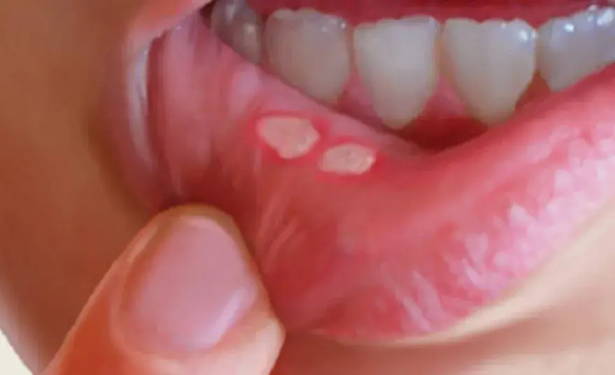 Afta a dentysta: Przełożyć wizytę czy iść? Jasne wskazówki.