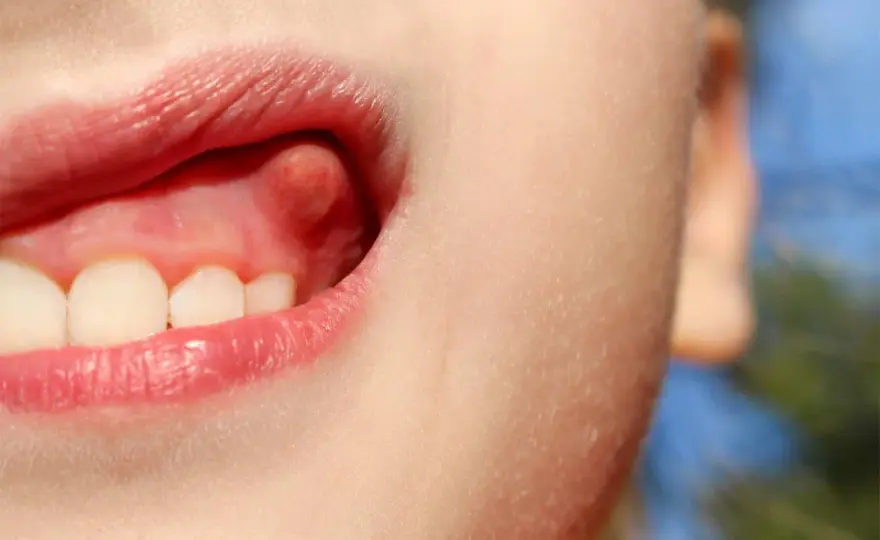 ¿Bulto en la encía? Causas y cuándo ir al dentista