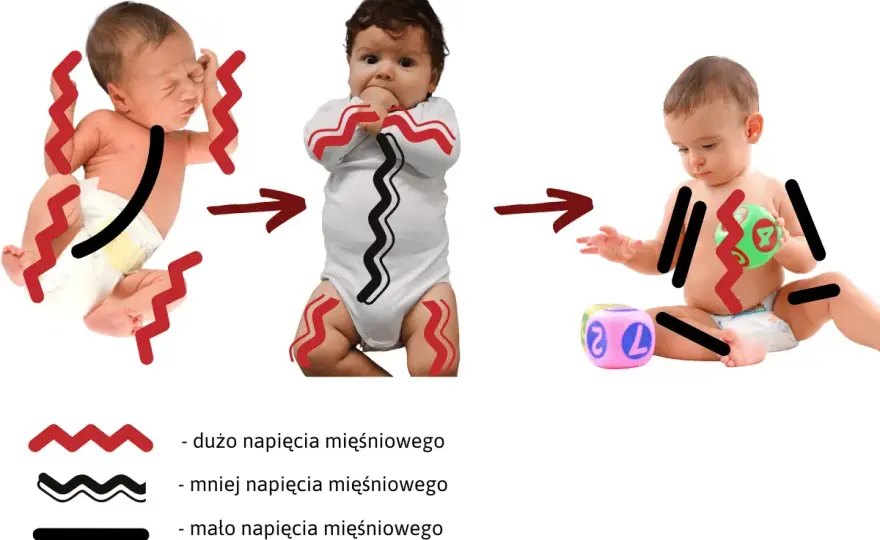 Wzmożone napięcie mięśniowe u niemowlęcia - objawy, kiedy reagować