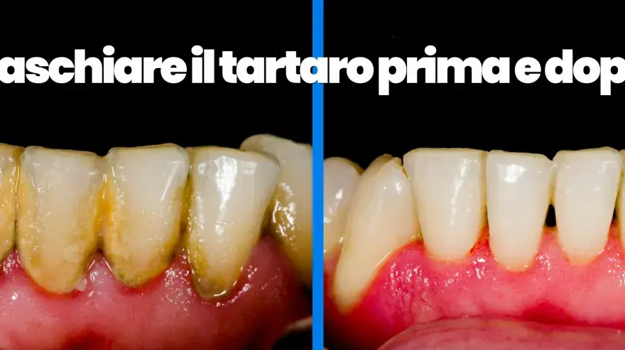 Tartaro sui denti - Cosa funziona davvero per eliminarlo?