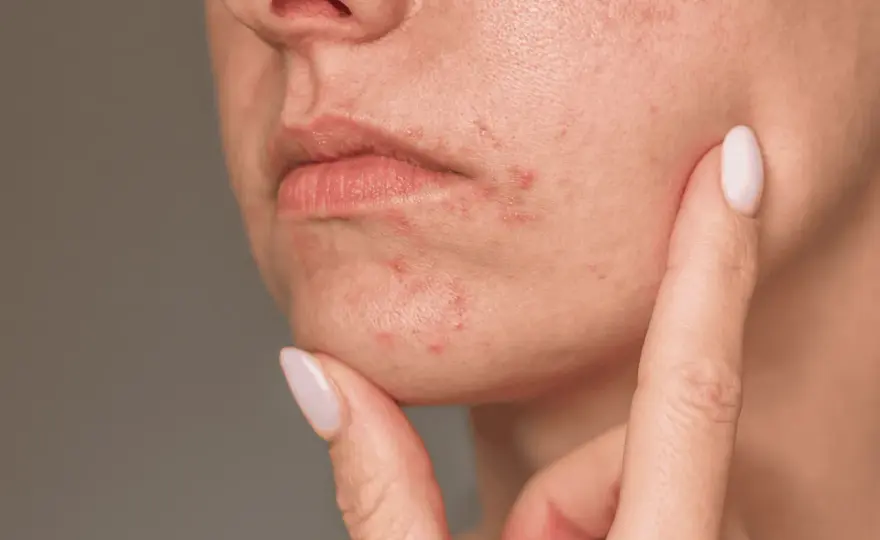 Perioral dermatit och sol - Så skyddar du huden rätt