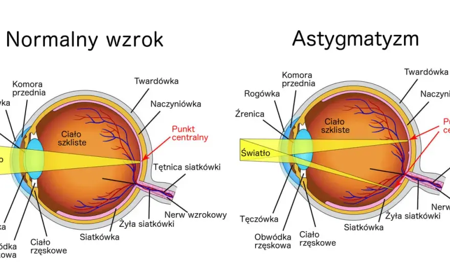 Astygmatyzm - Czy to tylko zmęczenie oczu? Objawy i rozpoznanie