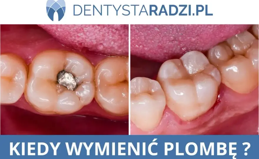 Plomba tymczasowa - dlaczego wypada i kiedy do dentysty?