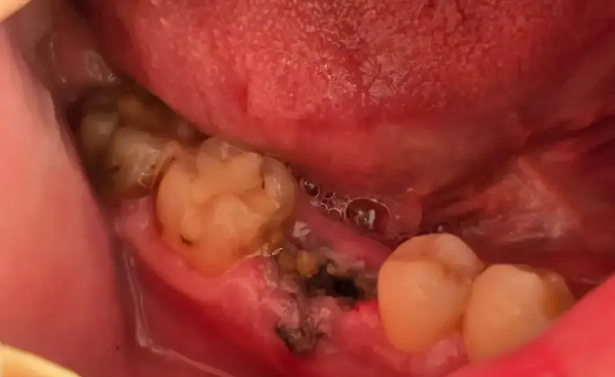 Resztki zęba w dziąśle po wyrwaniu - kiedy iść do dentysty?