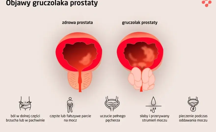 Prostata - objawy, diagnostyka, leczenie. Kiedy do urologa?