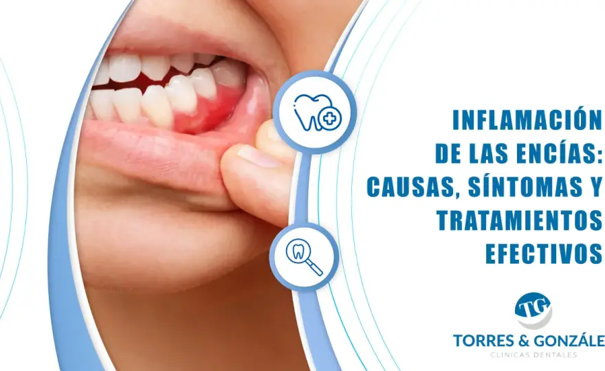 Gingivitis y encías inflamadas - síntomas y qué hacer