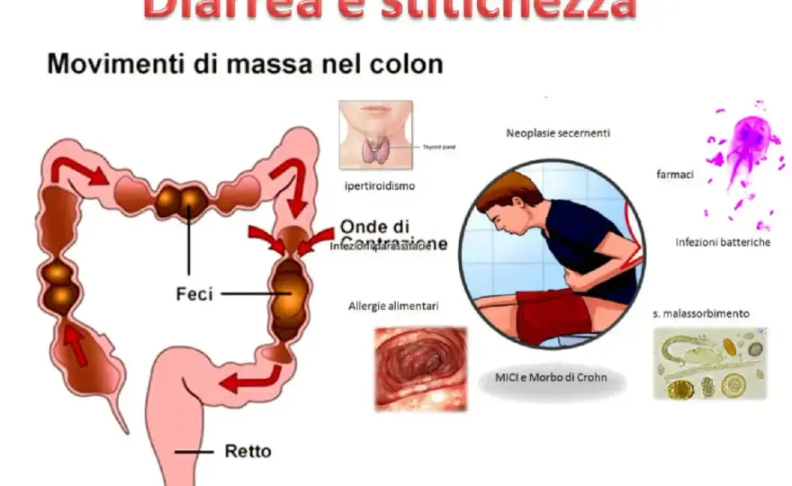 Stitichezza dopo la diarrea - cosa fare e quando preoccuparsi