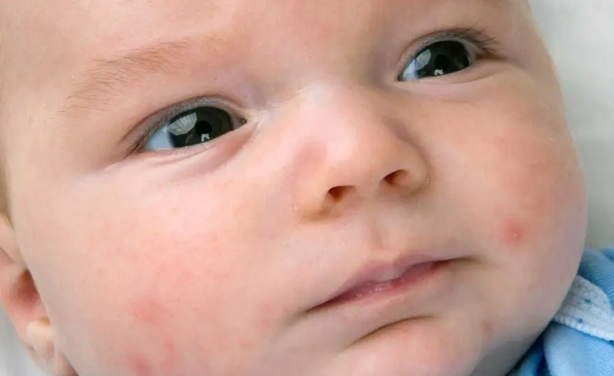 Brufoli sul viso del neonato, acne neonatale o altro?