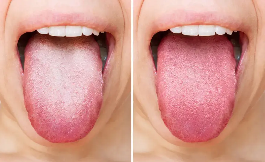 Suciedad en la lengua - causas y cómo limpiarla sin irritarla