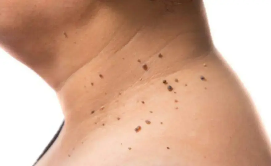 Manchas en el cuello - cómo distinguir sol, hongos o acantosis